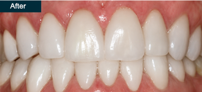 Patient smile after cosmetic treatment