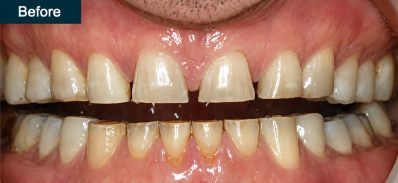 Patient smile before cosmetic treatment