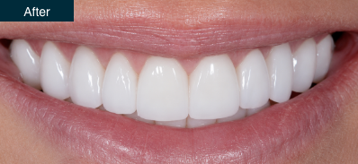 Patient smile after cosmetic treatment