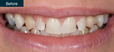 Patient smile before cosmetic treatment